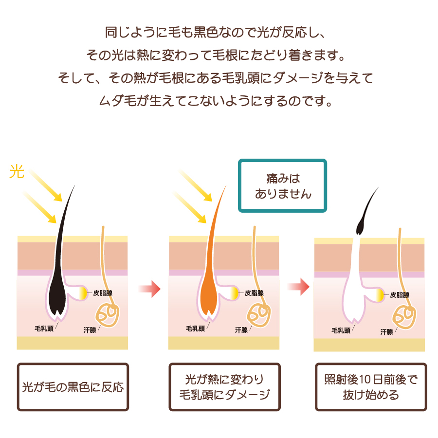 無痛＆スピーディー